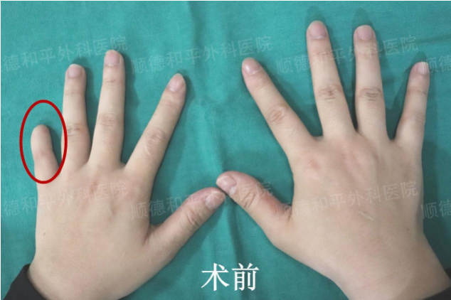 手指缺失多年可以做手指再造吗?